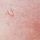 Hypersudation : Causes & traitement 